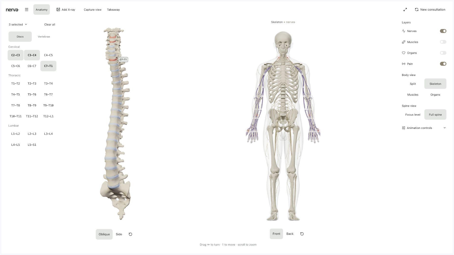 Body in View workspace with three cervical discs selected and purple nerve pathways on the skeleton.